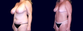Left 3/4 View - Breast Reduction and Tummy Tuck After Pregnancy