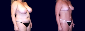 Right 3/4 View - Breast Reduction and Tummy Tuck After Pregnancy