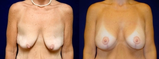 Frontal View - Breast Augmentation with Lift After Massive Weight Loss
