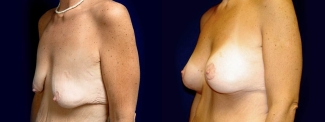 Left 3/4 View - Breast Augmentation with Lift After Massive Weight Loss