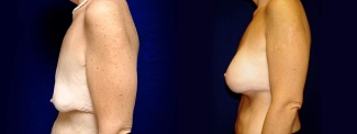 Left Profile View - Breast Augmentation with Lift After Massive Weight Loss