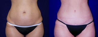 Frontal View - Tummy Tuck After Pregnancy