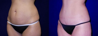 Left 3/4 View - Tummy Tuck After Pregnancy