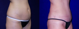 Right 3/4 View - Tummy Tuck After Pregnancy