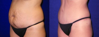 Left 3/4 View - Tummy Tuck and Liposuction