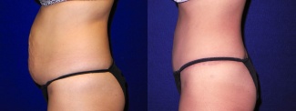 Left Profile View - Tummy Tuck and Liposuction