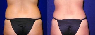 Back View - Tummy Tuck and Liposuction