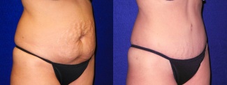 Right 3/4 View - Tummy Tuck and Liposuction