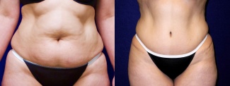 Frontal View - Tummy Tuck After Pregnancy