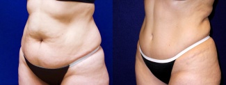 Left 3/4 View - Tummy Tuck After Pregnancy