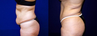 Left Profile View - Tummy Tuck After Pregnancy