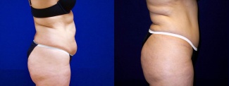 Right Profile View - Tummy Tuck After Pregnancy