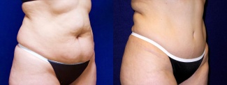 Right 3/4 View - Tummy Tuck After Pregnancy