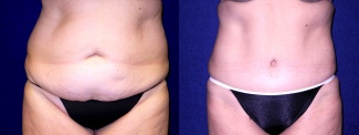 Frontal View - Tummy Tuck After Pregnancy