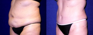 Left 3/4 View - Tummy Tuck After Pregnancy