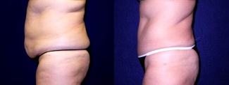 Left Profile View - Tummy Tuck After Pregnancy