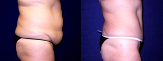 Right Profile View - Tummy Tuck After Pregnancy