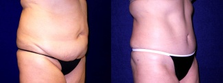 Right 3/4 View - Tummy Tuck After Pregnancy