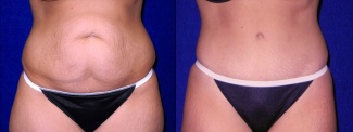 Frontal View - Tummy Tuck After Pregnancy