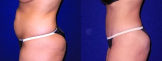 Left Profile View - Tummy Tuck After Pregnancy