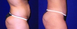 Right Profile View - Tummy Tuck After Pregnancy