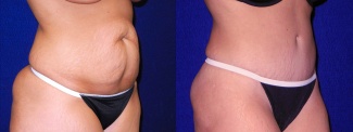 Right 3/4 View - Tummy Tuck After Pregnancy