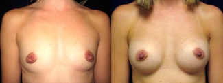 Frontal View - Breast Augmentation After Pregnancy