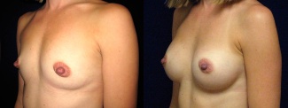 Left 3/4 View - Breast Augmentation After Pregnancy