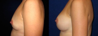 Left Profile View - Breast Augmentation After Pregnancy