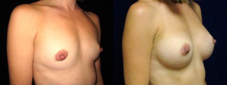 Right 3/4 View - Breast Augmentation After Pregnancy