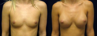 Frontal View - Breast Augmentation - Silicone Implants