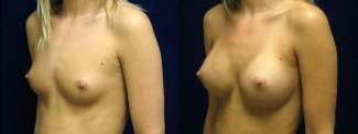 Left 3/4 View - Breast Augmentation - Silicone Implants