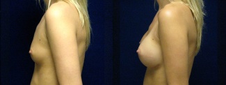 Left Profile View - Breast Augmentation - Silicone Implants