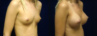 Right 3/4 View - Breast Augmentation - Silicone Implants