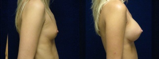 Right Profile View - Breast Augmentation - Silicone Implants