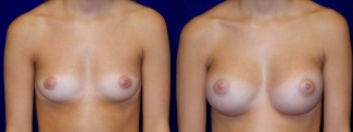 Frontal View - Breast Augmentation - Silicone Implants