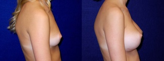 Right Profile View - Breast Augmentation - Silicone Implants