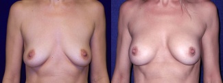 Frontal View - Breast Augmentation After Pregnancy - Silicone Implants