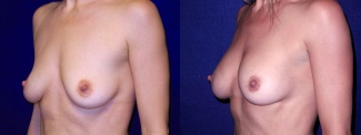 Left 3/4 View - Breast Augmentation After Pregnancy - Silicone Implants
