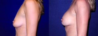Left Profile View - Breast Augmentation After Pregnancy - Silicone Implants