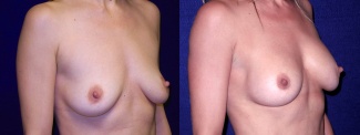 Right 3/4 View - Breast Augmentation After Pregnancy - Silicone Implants