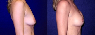 Right Profile View - Breast Augmentation After Pregnancy - Silicone Implants