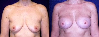 Frontal View - Breast Augmentation - Silicone Implants