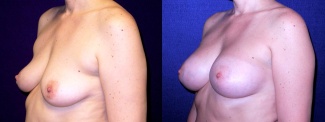 Left 3/4 View - Breast Augmentation - Silicone Implants