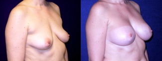 Right 3/4 View - Breast Augmentation - Silicone Implants