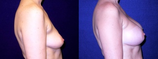 Right Profile View - Breast Augmentation - Silicone Implants