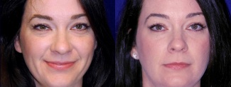 Frontal View - Lower Eyelid Surgery