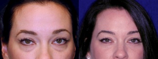 Frontal View - Lower Eyelid Surgery