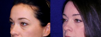 Left 3/4 View - Lower Eyelid Surgery