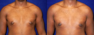 Frontal View - Gynecomastia